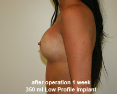 plastic-surgery-breast-augmentation